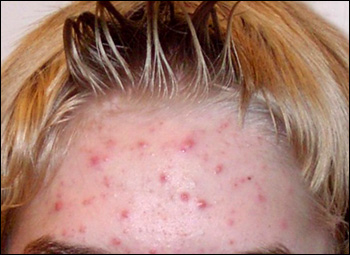 Hormonal imbalances due to pcos may cause acne. Picture of woman with acne on her forehead.